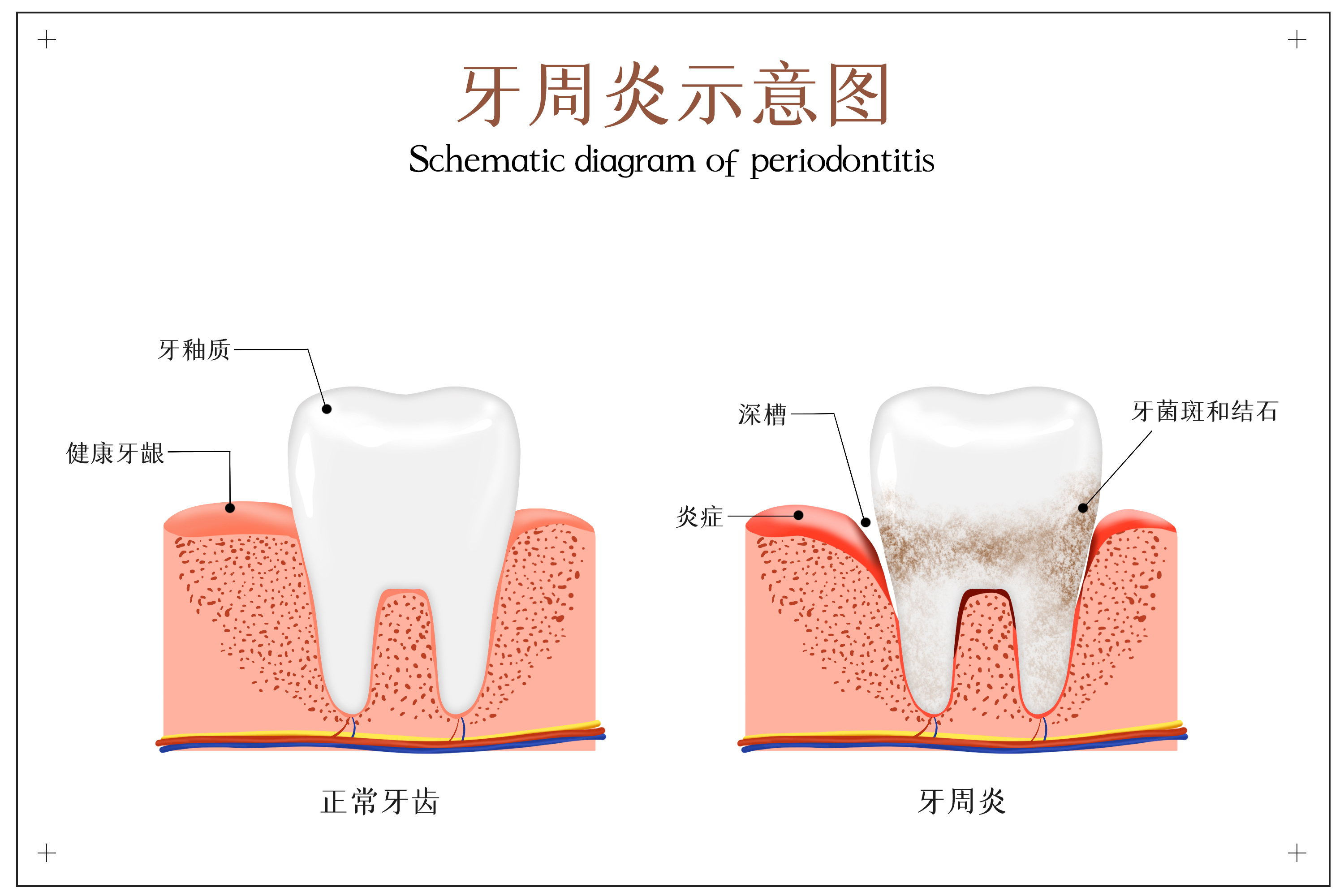 摄图网_401803633_牙周炎示意图（非企业商(shāng)用(yòng)）.jpg