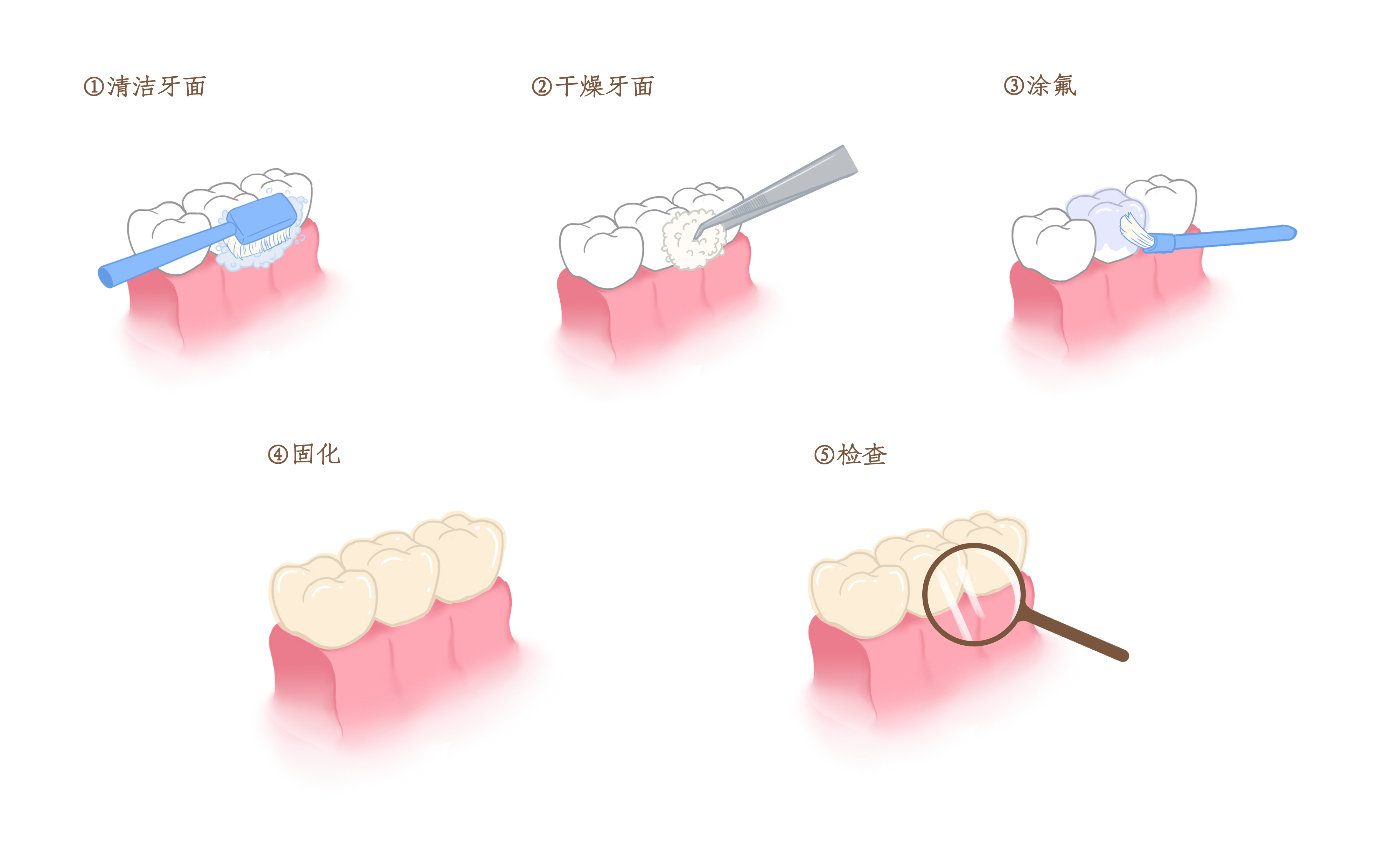 摄图网_401800107_牙齿涂氟步骤科(kē)普插画（非企业商(shāng)用(yòng)）.jpg